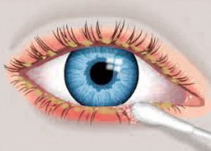 blepharitis-inflammation0of-eyelids