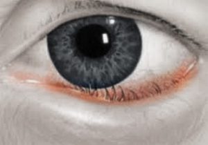 entropion-inversion-lower-eyelid